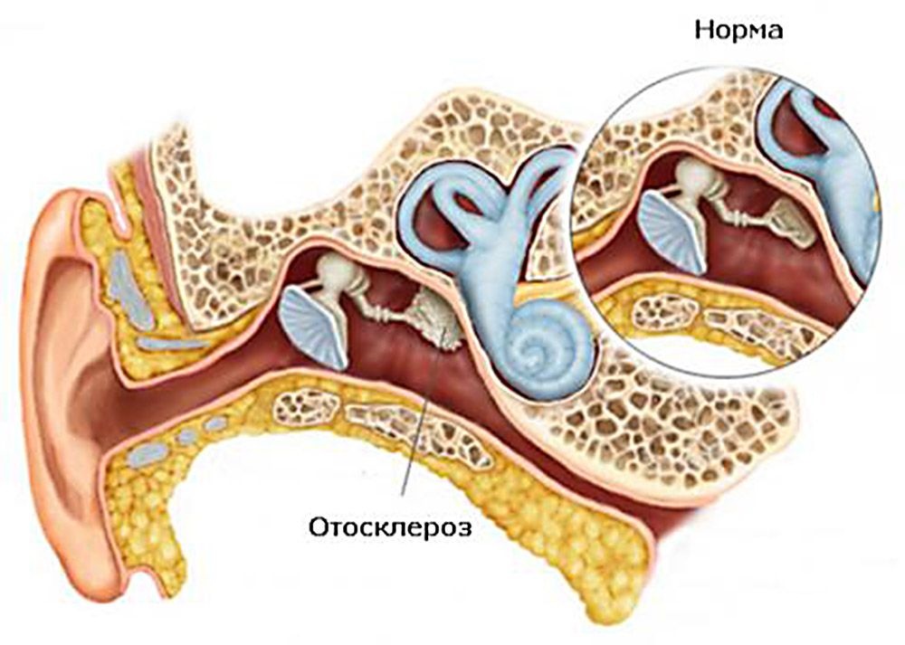otoskleroz-1